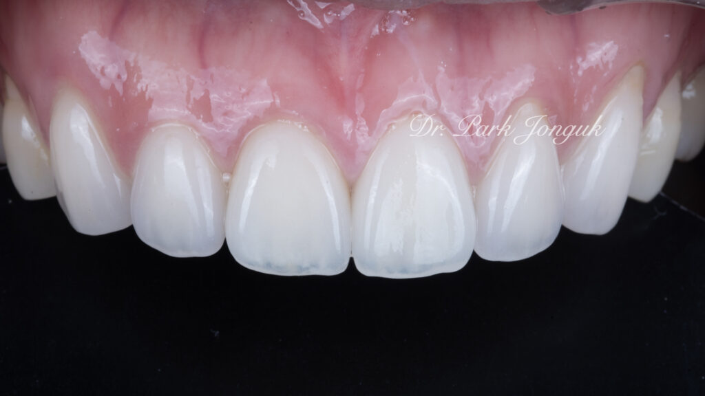 자연스러운 라미네이트
Dr. Park Jonguk performing natural laminate veneer at Dream Dental Clinic