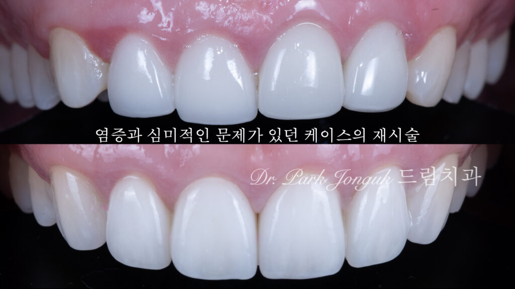 라미네이트 재시술
Dr. Park Jonguk performing natural laminate veneer at Dream Dental Clinic