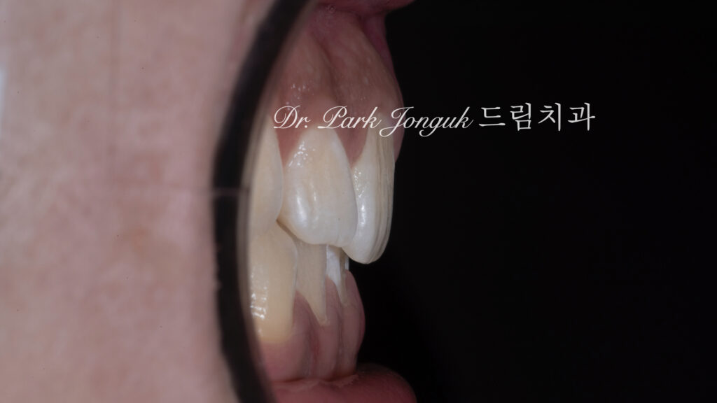 옥니상태는 무삭제 라미네이트에 유리