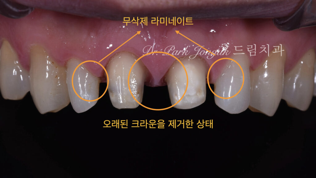 PFM 저게한 상태