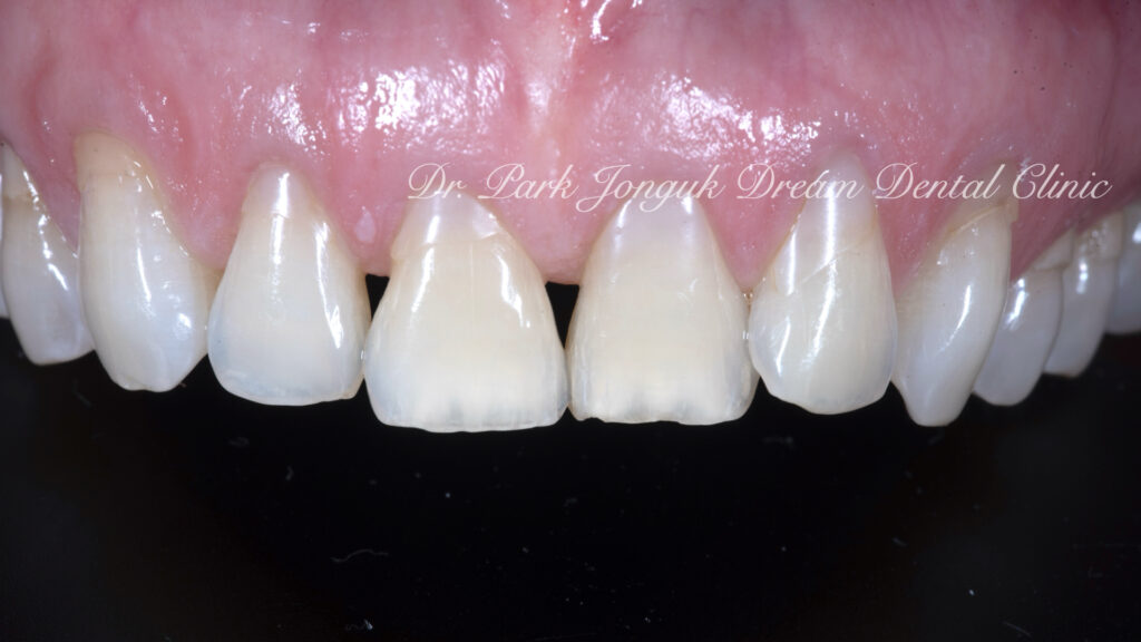 블랙트라이앵글의 라미네이트 치료