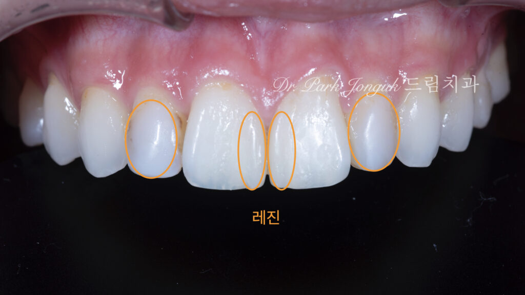 앞니 레진 변색 라미네이트