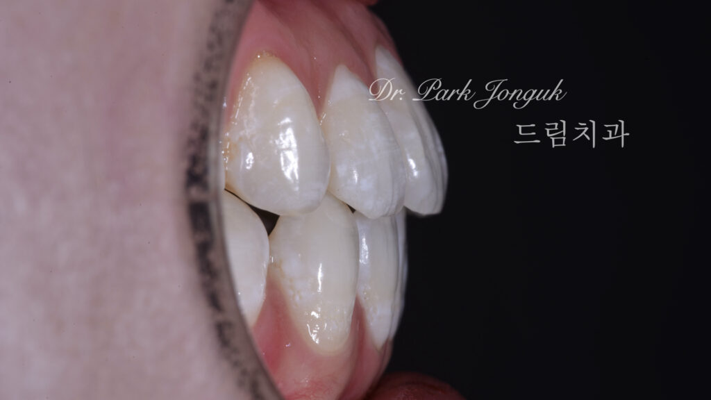 뻐드러진치아 라미네이트