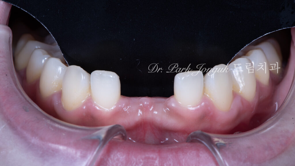 Anterior Maryland Bridge 앞니 메릴랜드 브릿지