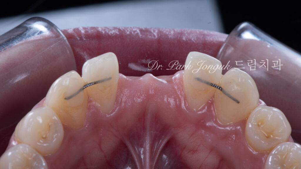 Anterior Maryland Bridge 앞니 메릴랜드 브릿지
