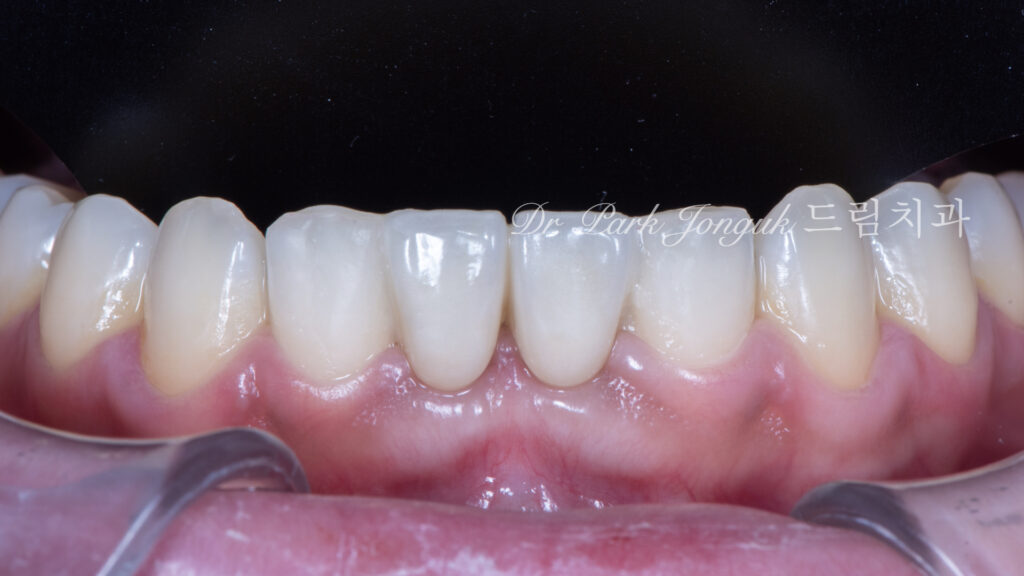 Anterior Maryland Bridge 앞니 메릴랜드 브릿지