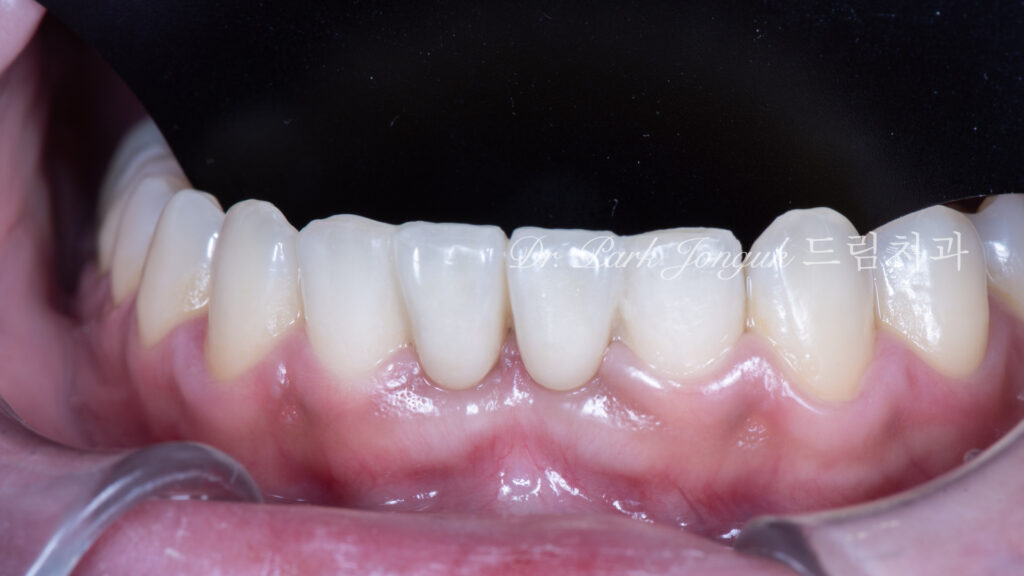Anterior Maryland Bridge 앞니 메릴랜드 브릿지