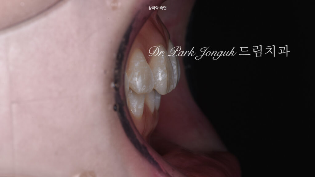 앞니 변색 얼룩 치아 라미네이트 치료
