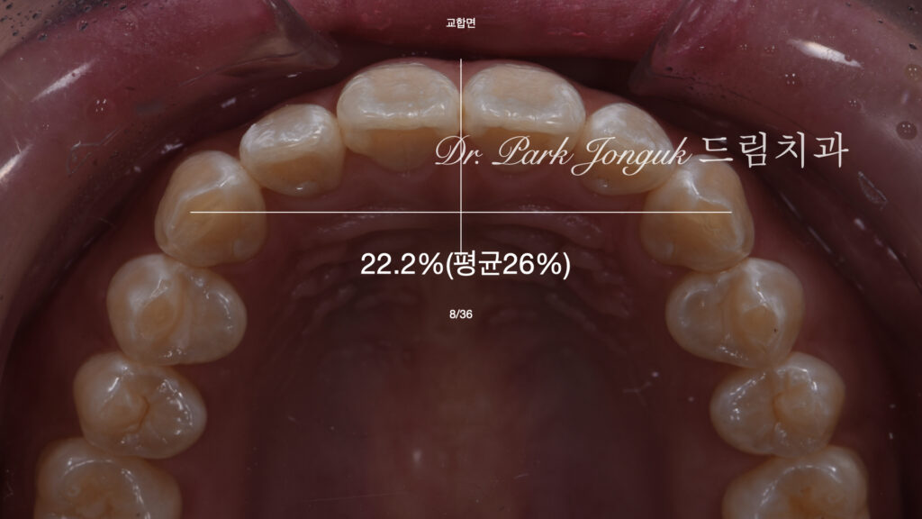 앞니 변색 얼룩 치아 라미네이트 치료