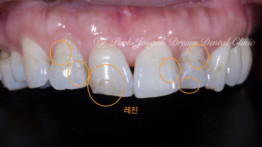 앞니 충치 레진변색 라미네이트