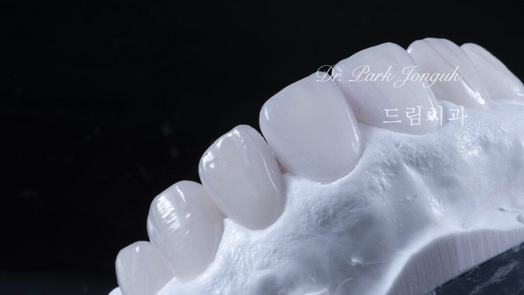 교정후 옥니 무삭제 라미네이트
