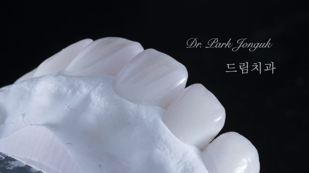 교정후 옥니 무삭제 라미네이트