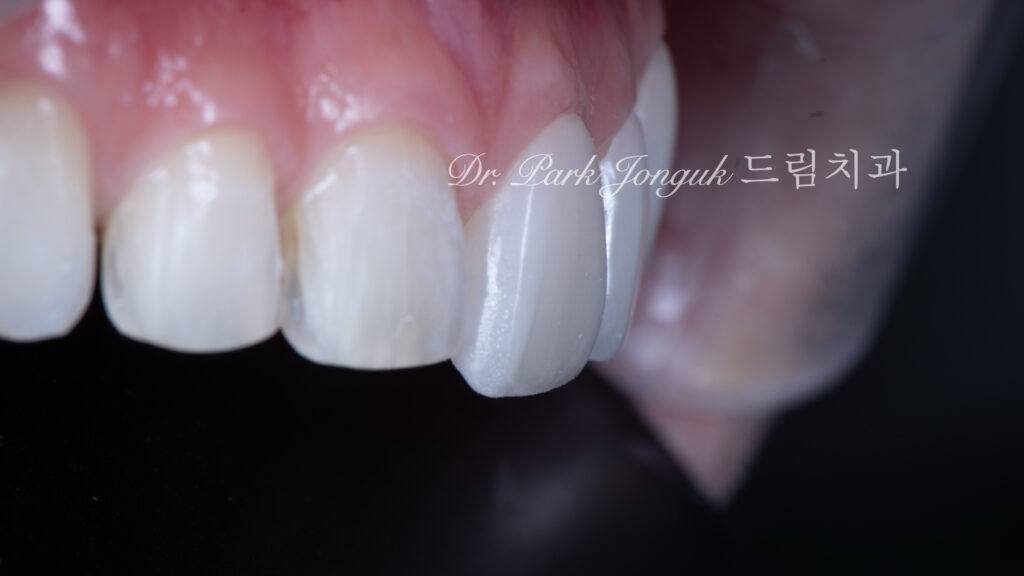 무삭제 라미네이트