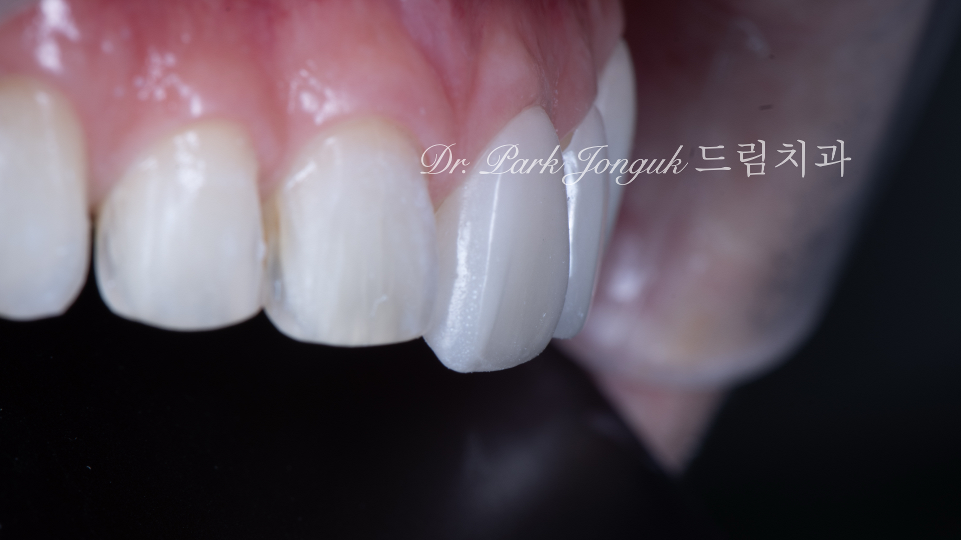 무삭제 라미네이트
