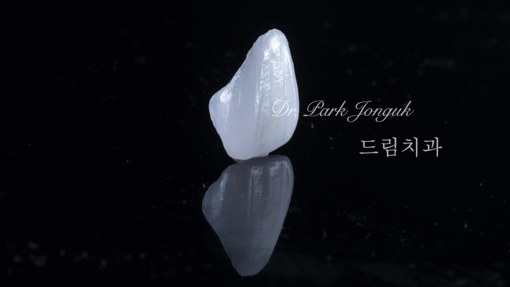 교정후 옥니 무삭제 라미네이트