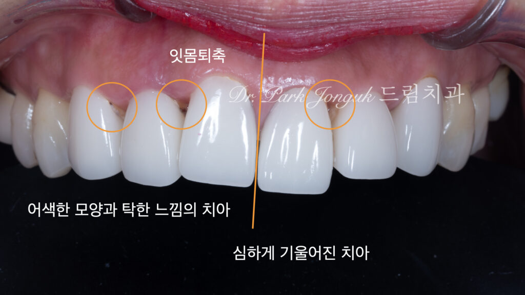 라미네이트 재시술