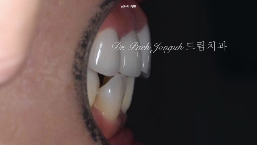 라미네이트 재시술