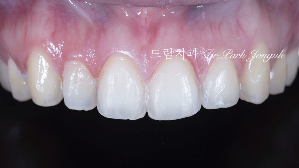 강남 토끼이 라미네이트 잘하는곳