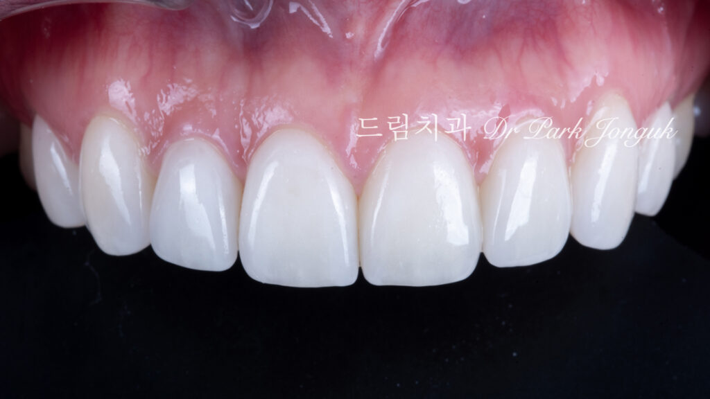 강남 토끼이 라미네이트 잘하는곳