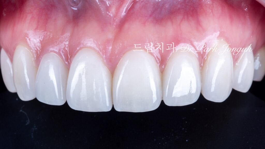 강남 토끼이 라미네이트 잘하는곳