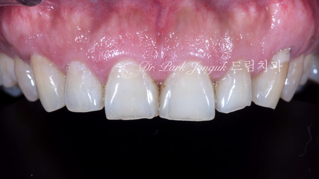 50대라미네이트, 치아노화라미네이트, 치아마모라미네이트, AgingTeeth, LaminateVeneers, ToothWear, 심미치과, 앞니라미네이트, 자연스러운라미네이트, 동안치아