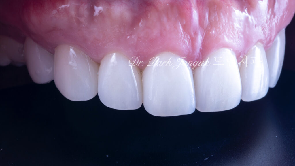 50대라미네이트, 치아노화라미네이트, 치아마모라미네이트, AgingTeeth, LaminateVeneers, ToothWear, 심미치과, 앞니라미네이트, 자연스러운라미네이트, 동안치아