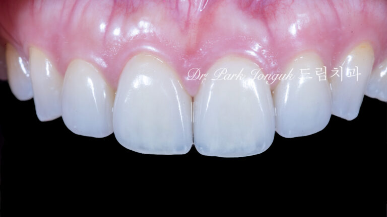 라미네이트 재시술, Laminate Revision, 올세라믹 크라운 재치료, All-Ceramic Crown Revision, 심미 보철 재건, Esthetic Prosthetic Reconstruction, 수작업 빌드업, Hand-Layered Build-up