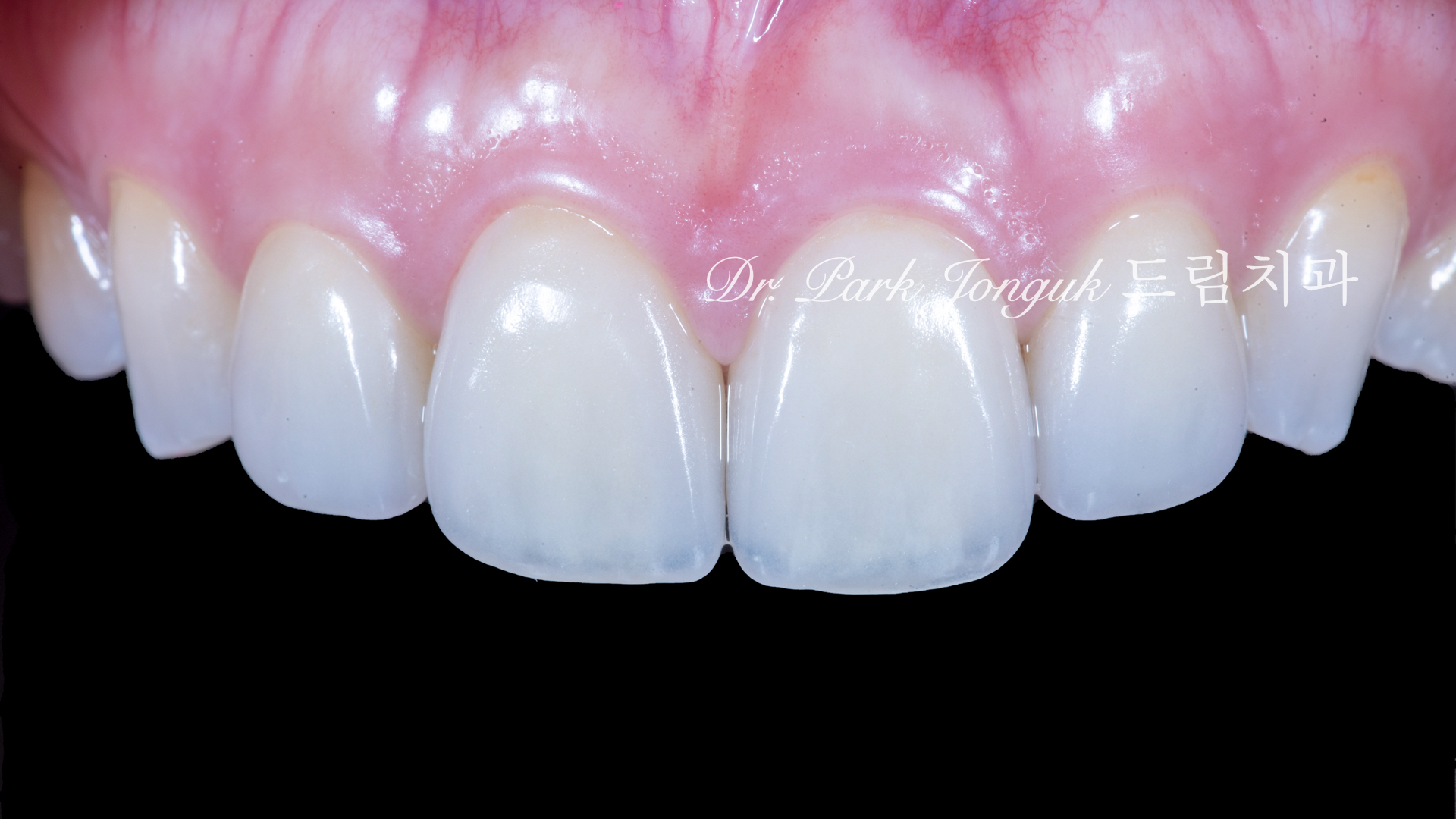 라미네이트 재시술, Laminate Revision, 올세라믹 크라운 재치료, All-Ceramic Crown Revision, 심미 보철 재건, Esthetic Prosthetic Reconstruction, 수작업 빌드업, Hand-Layered Build-up