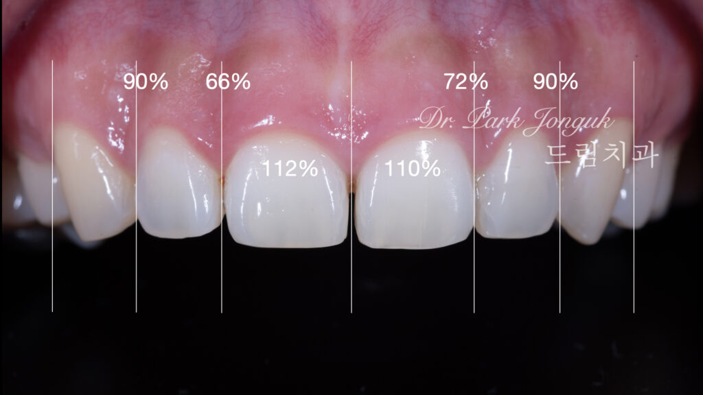 무삭제 라미네이트, No-Prep Laminate, 옥니, Retroclined Teeth, 왜소치, Microdontia, 정중이개, Midline Diastema, 치은 성형, Gingivectomy, 최소 침습, Minimally Invasive