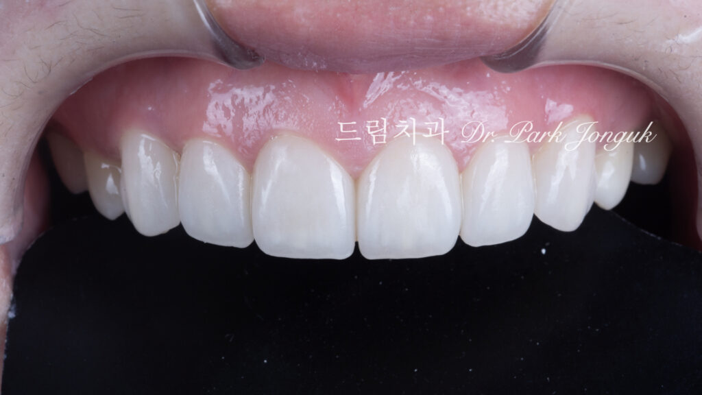 무삭제 라미네이트