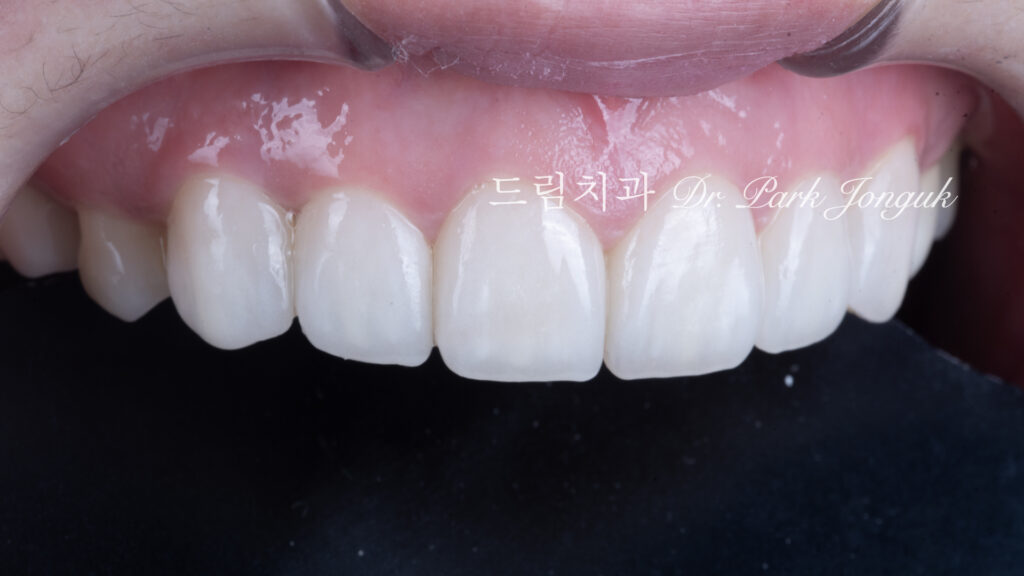 무삭제 라미네이트