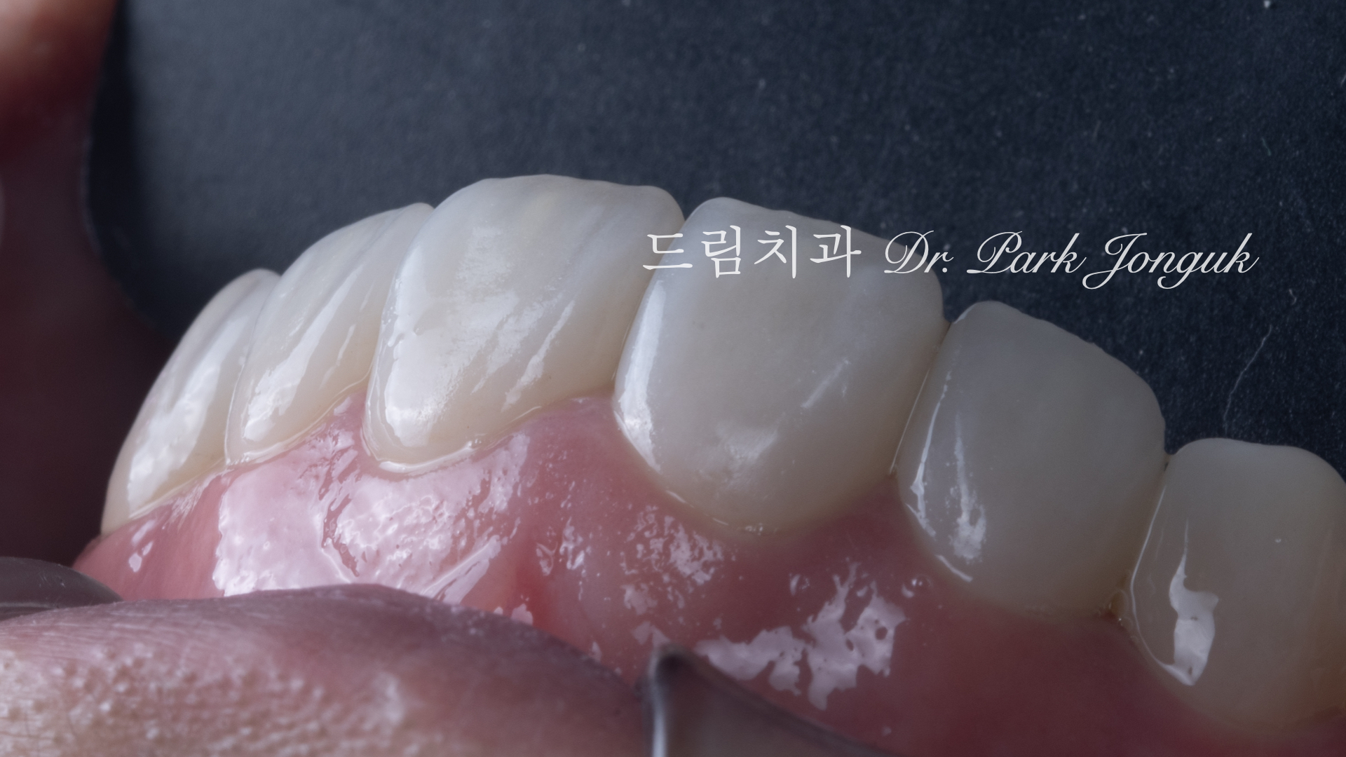 무삭제 라미네이트