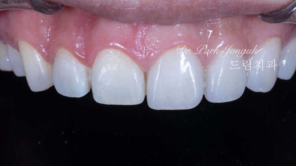 무삭제 라미네이트, No-Prep Laminate, 옥니, Retroclined Teeth, 왜소치, Microdontia, 정중이개, Midline Diastema, 치은 성형, Gingivectomy, 최소 침습, Minimally Invasive