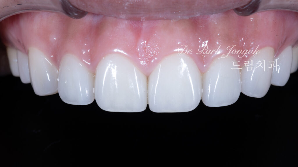 무삭제 라미네이트, No-Prep Laminate, 옥니, Retroclined Teeth, 왜소치, Microdontia, 정중이개, Midline Diastema, 치은 성형, Gingivectomy, 최소 침습, Minimally Invasive