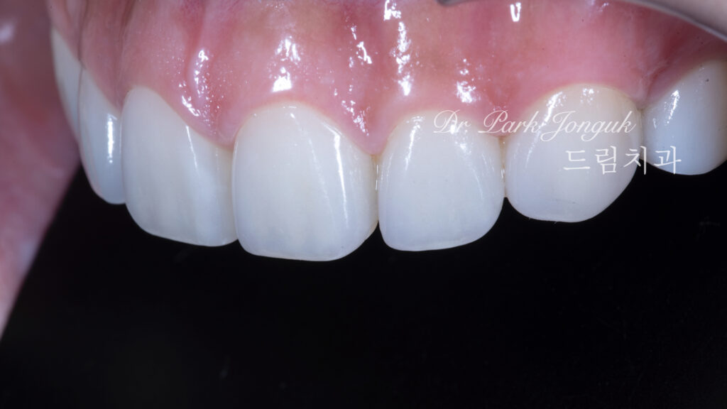 무삭제 라미네이트, No-Prep Laminate, 옥니, Retroclined Teeth, 왜소치, Microdontia, 정중이개, Midline Diastema, 치은 성형, Gingivectomy, 최소 침습, Minimally Invasive