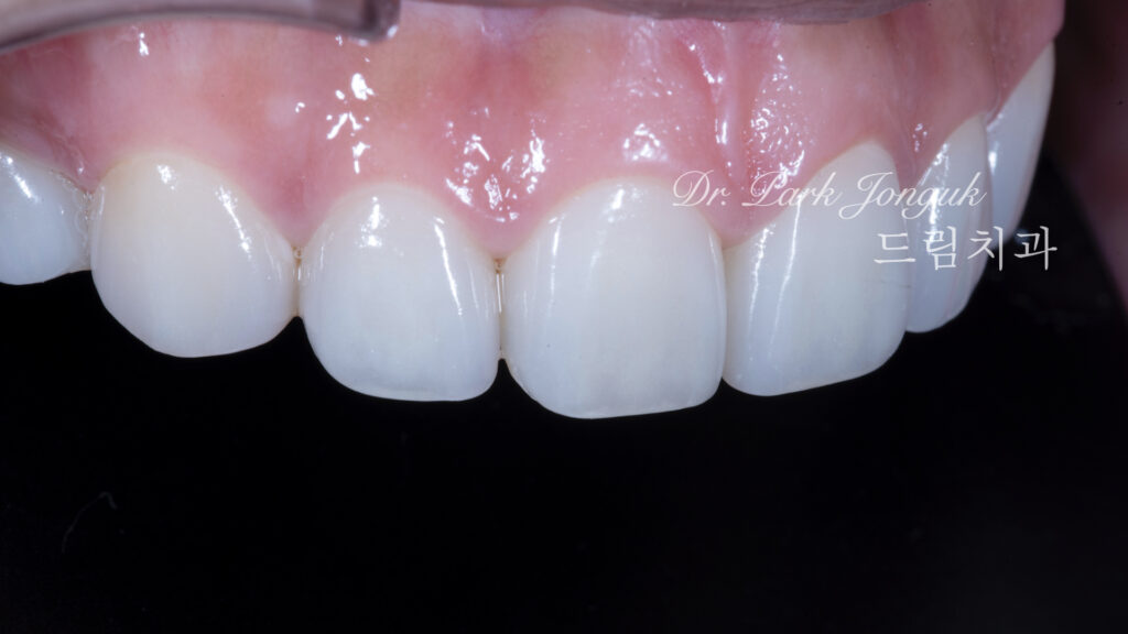 무삭제 라미네이트, No-Prep Laminate, 옥니, Retroclined Teeth, 왜소치, Microdontia, 정중이개, Midline Diastema, 치은 성형, Gingivectomy, 최소 침습, Minimally Invasive
