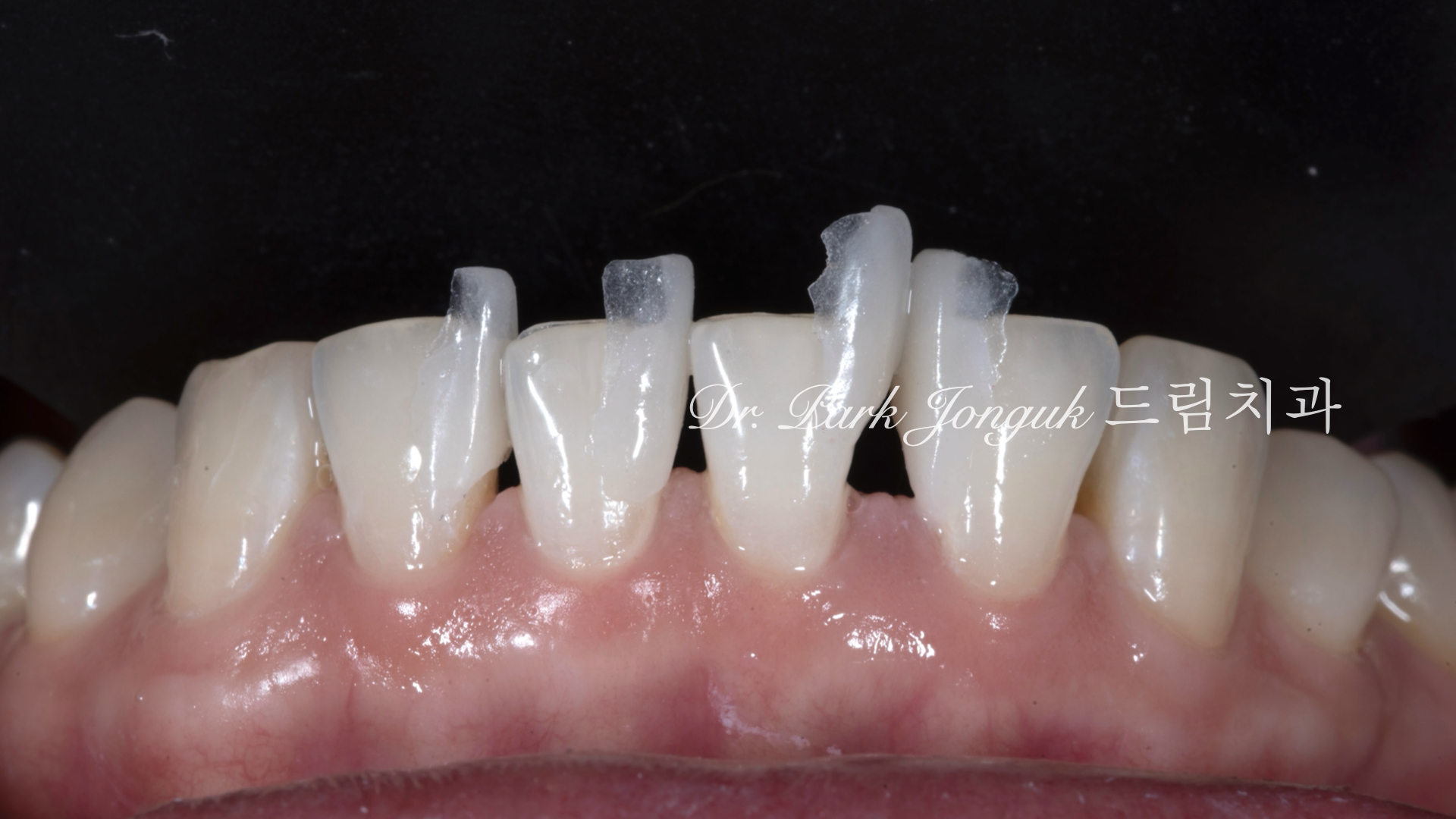 라미네이트, 무삭제 라미네이트, 치아사이공간, 벌어진치아 라미네이트, diastema, gap teeth, laminate veneer, no-prep veneer, 앞니 라미네이트, 자연스러운 라미네이트, 심미치과, 세라믹 라미네이트, feldspathic veneer, 강남 라미네이트, Dream Dental Clinic, cosmetic dentistry