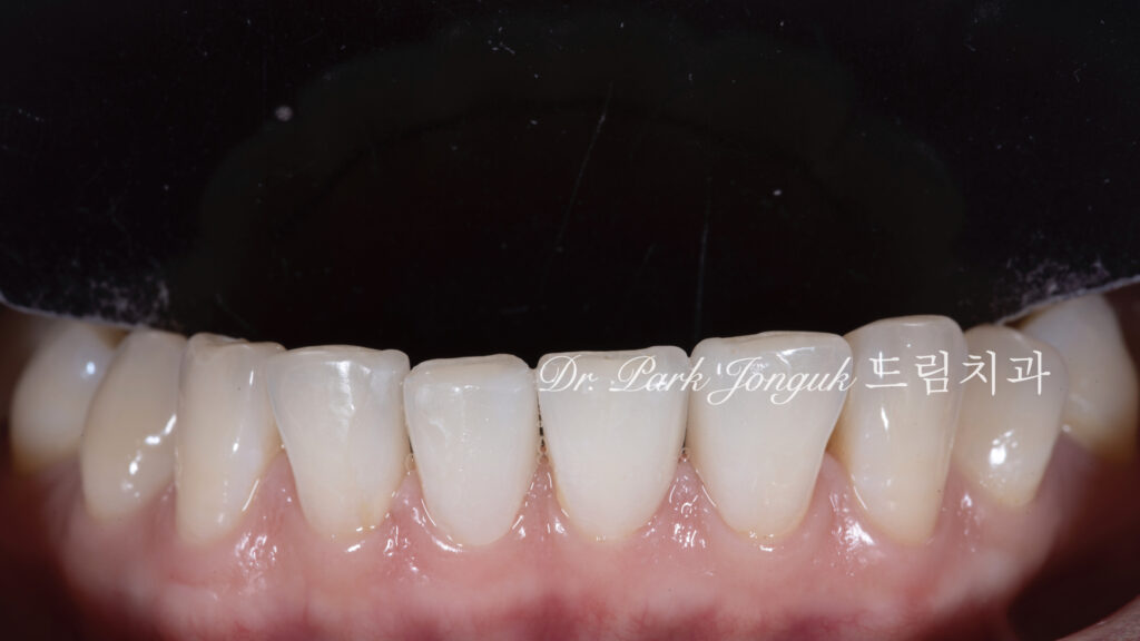 라미네이트, 무삭제 라미네이트, 치아사이공간, 벌어진치아 라미네이트, diastema, gap teeth, laminate veneer, no-prep veneer, 앞니 라미네이트, 자연스러운 라미네이트, 심미치과, 세라믹 라미네이트, feldspathic veneer, 강남 라미네이트, Dream Dental Clinic, cosmetic dentistry