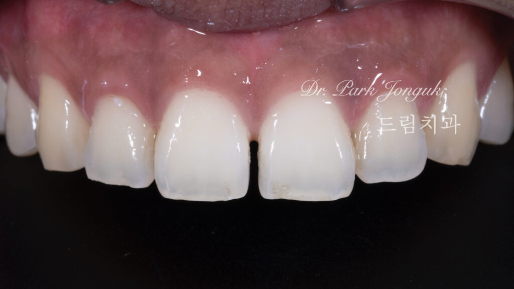 라미네이트, 무삭제 라미네이트, 치아사이공간, 벌어진치아 라미네이트, diastema, gap teeth, laminate veneer, no-prep veneer, 앞니 라미네이트, 자연스러운 라미네이트, 심미치과, 세라믹 라미네이트, feldspathic veneer, 강남 라미네이트, Dream Dental Clinic, cosmetic dentistry