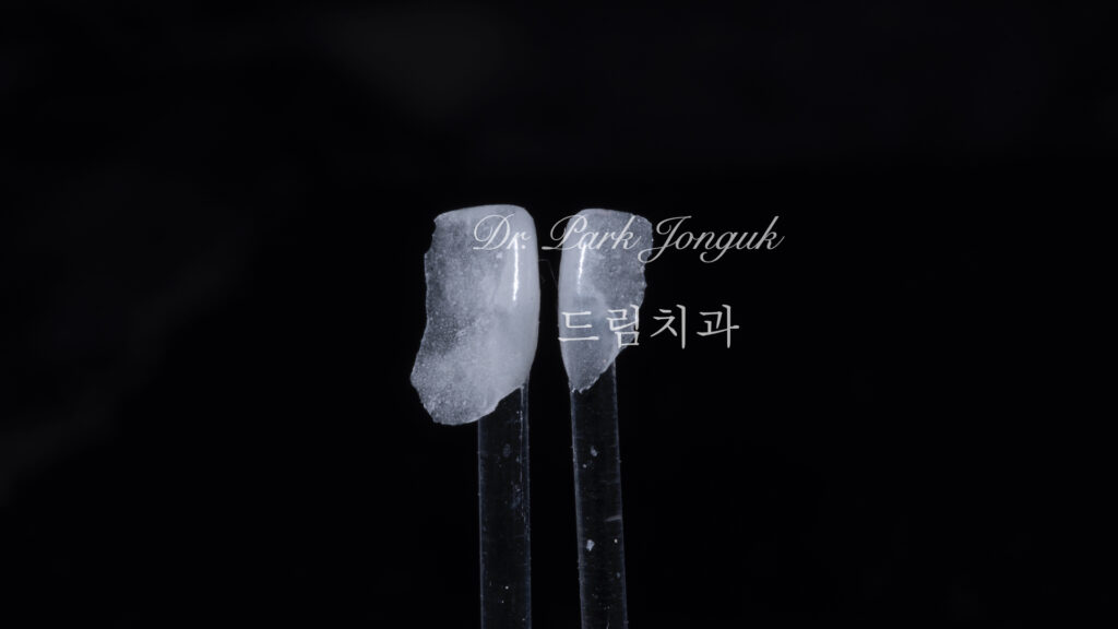 라미네이트, 무삭제 라미네이트, 치아사이공간, 벌어진치아 라미네이트, diastema, gap teeth, laminate veneer, no-prep veneer, 앞니 라미네이트, 자연스러운 라미네이트, 심미치과, 세라믹 라미네이트, feldspathic veneer, 강남 라미네이트, Dream Dental Clinic, cosmetic dentistry
