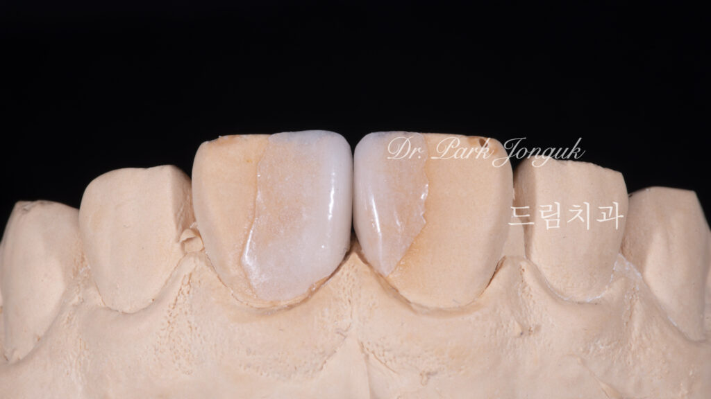 라미네이트, 무삭제 라미네이트, 치아사이공간, 벌어진치아 라미네이트, diastema, gap teeth, laminate veneer, no-prep veneer, 앞니 라미네이트, 자연스러운 라미네이트, 심미치과, 세라믹 라미네이트, feldspathic veneer, 강남 라미네이트, Dream Dental Clinic, cosmetic dentistry