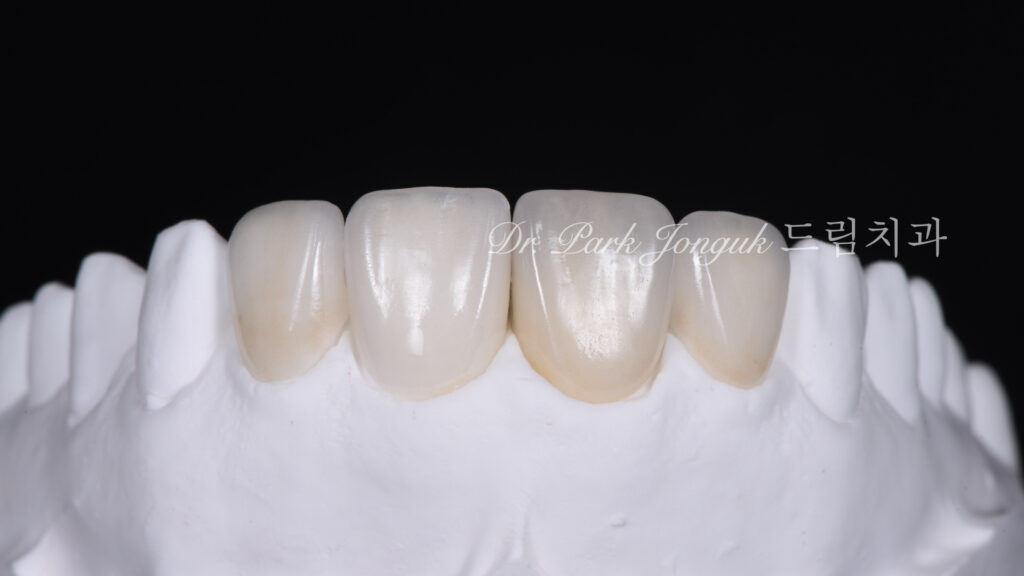 올세라믹 크라운 재시술, All-Ceramic Crown Revision, 라미네이트, Laminate Veneer, 색상 매칭, Color Matching, 광학적 특성, Optical Properties, 여성적 심미, Feminine Esthetics