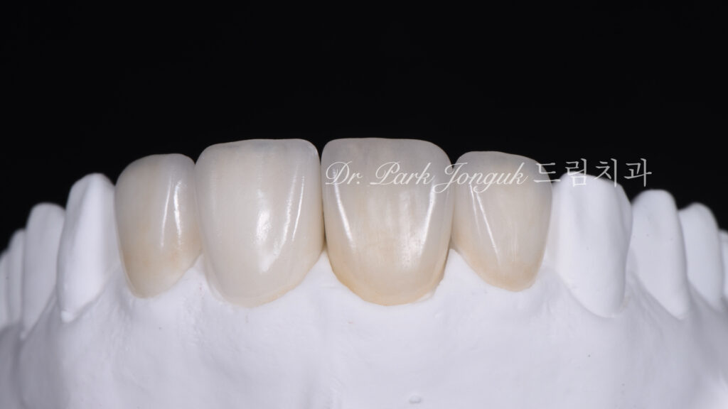 올세라믹 크라운 재시술, All-Ceramic Crown Revision, 라미네이트, Laminate Veneer, 색상 매칭, Color Matching, 광학적 특성, Optical Properties, 여성적 심미, Feminine Esthetics