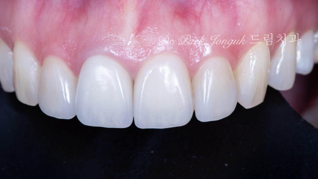 올세라믹 크라운 재시술, All-Ceramic Crown Revision, 라미네이트, Laminate Veneer, 색상 매칭, Color Matching, 광학적 특성, Optical Properties, 여성적 심미, Feminine Esthetics