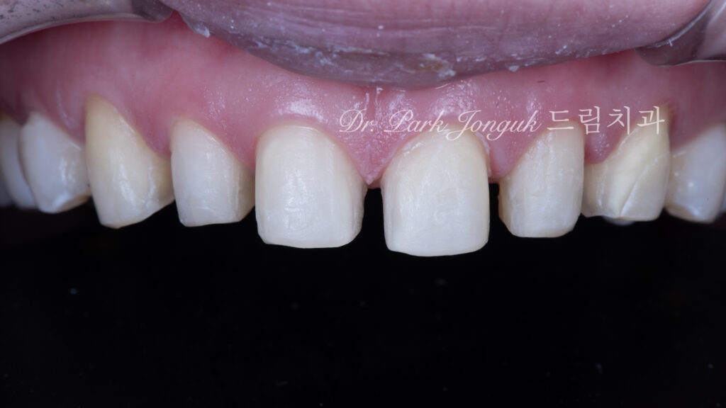 라미네이트 재시술, Laminate Revision, 불투명한 라미네이트, Opaque Laminate, 비자연적 백색, Unnatural Whiteness, 레이저 제거, Laser Removal, 수작업 빌드업, Hand-Layered Build-up