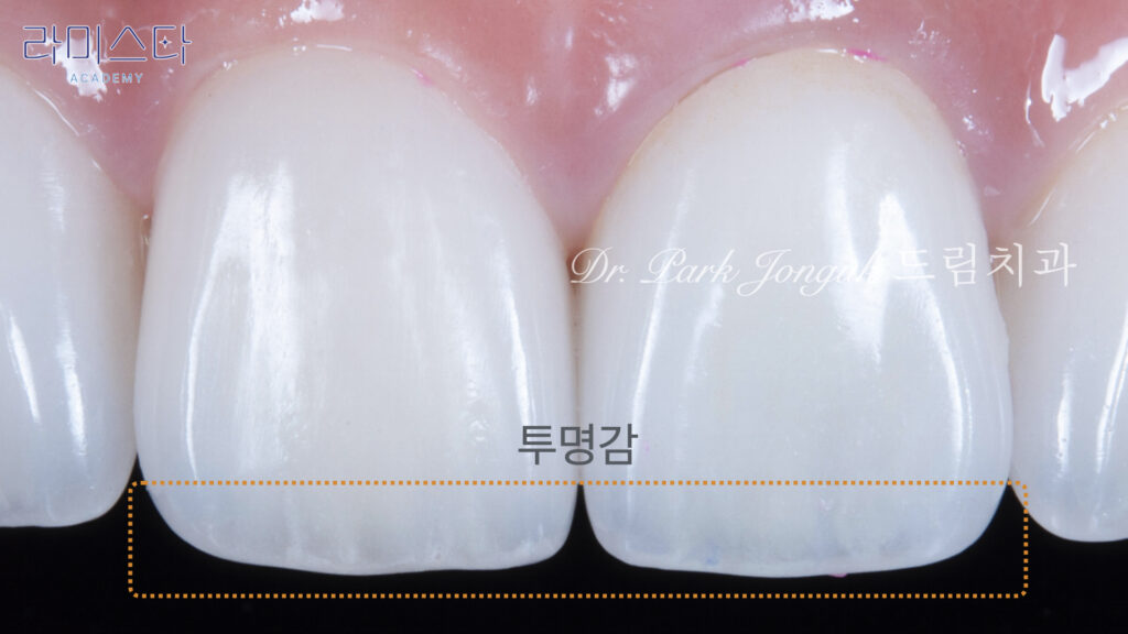 라미네이트 제작 방법, Laminate Fabrication Methods, 수작업 빌드업, Hand-Layered Build-up, CAD/CAM 밀링, CAD/CAM Milling, E-max 베이스, E-max Base, 자연스러운 라미네이트, Natural Laminate