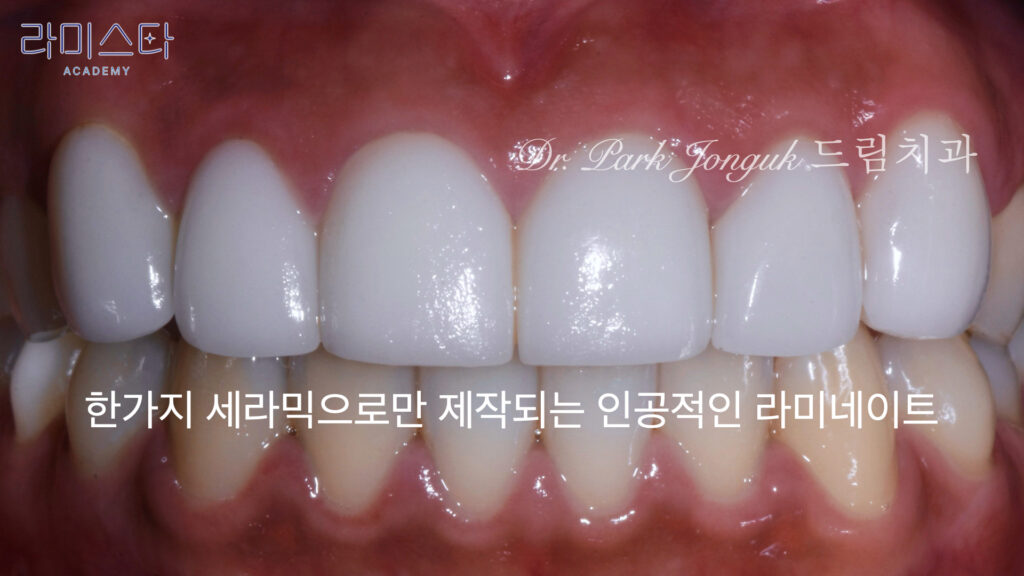 라미네이트 제작 방법, Laminate Fabrication Methods, 수작업 빌드업, Hand-Layered Build-up, CAD/CAM 밀링, CAD/CAM Milling, E-max 베이스, E-max Base, 자연스러운 라미네이트, Natural Laminate