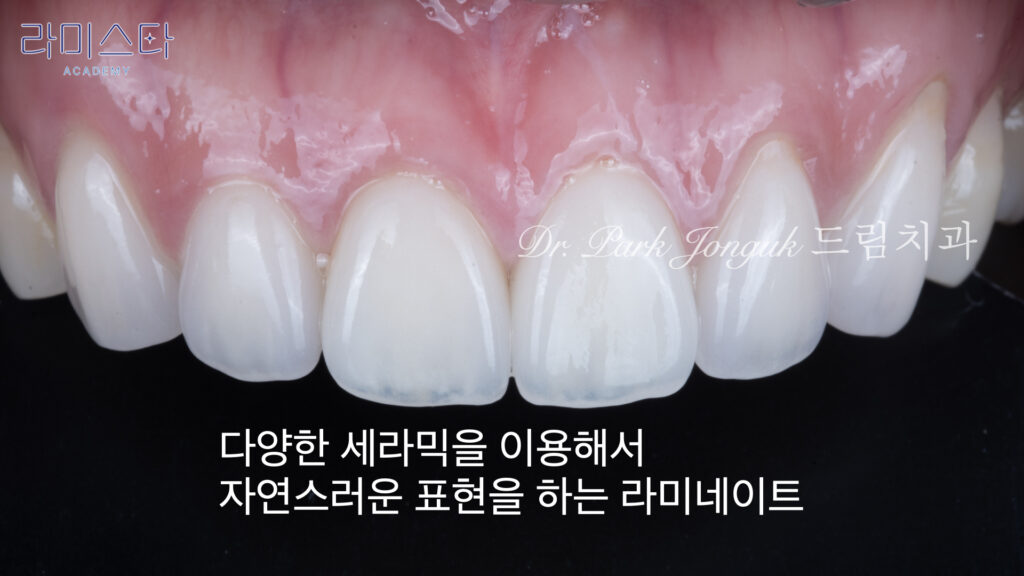 라미네이트 제작 방법, Laminate Fabrication Methods, 수작업 빌드업, Hand-Layered Build-up, CAD/CAM 밀링, CAD/CAM Milling, E-max 베이스, E-max Base, 자연스러운 라미네이트, Natural Laminate
