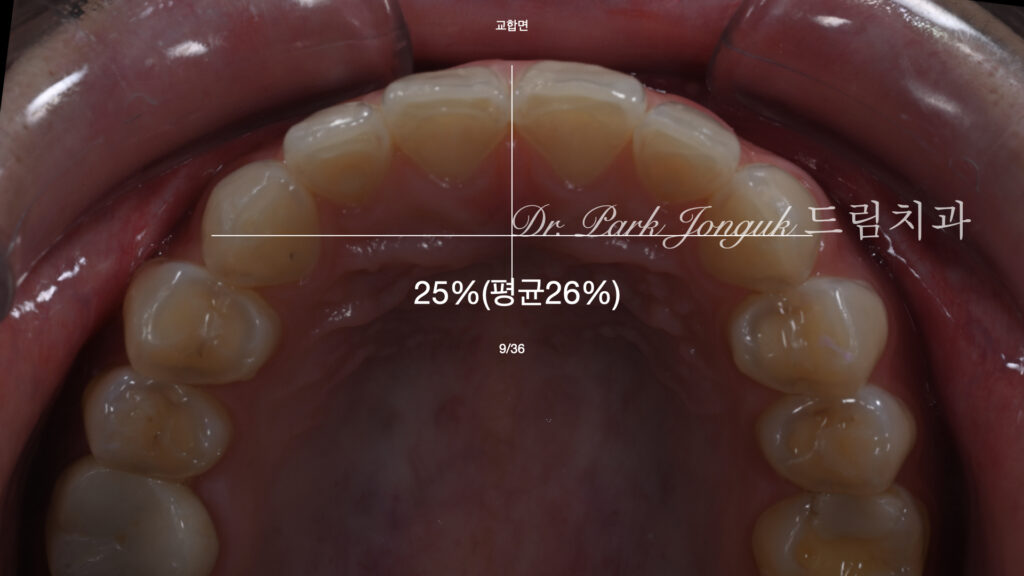 앞니라미네이트, 무삭제라미네이트, 앞니마모치료, 최소삭제라미네이트, 앞니심미보철, 압구정드림치과, 박종욱원장, 보존과전문의, 라미네이트잘하는곳, 치아정밀진단, 핸드메이드보철, 앞니심미재건