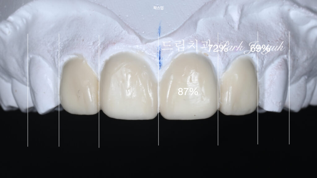 라미네이트 재시술, Laminate Revision, 라미네이트 재치료, Laminate Re-treatment, 자연스러운 라미네이트, Natural Laminate, 레이저 라미네이트 제거, Laser Laminate Removal, 과대 크기 교정, Oversized Correction
